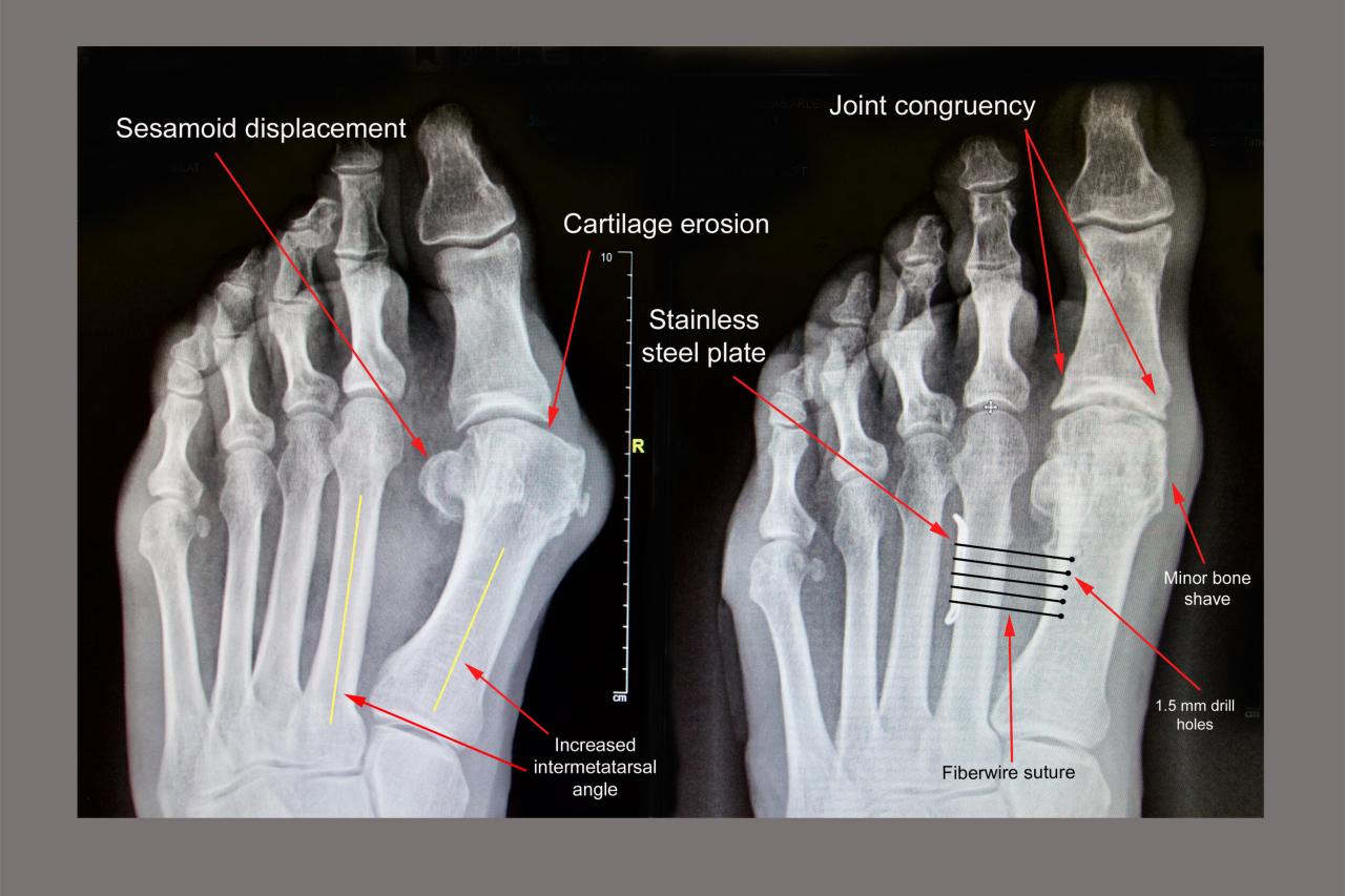 Types of Bunion Surgery: Find the Right Procedure for You